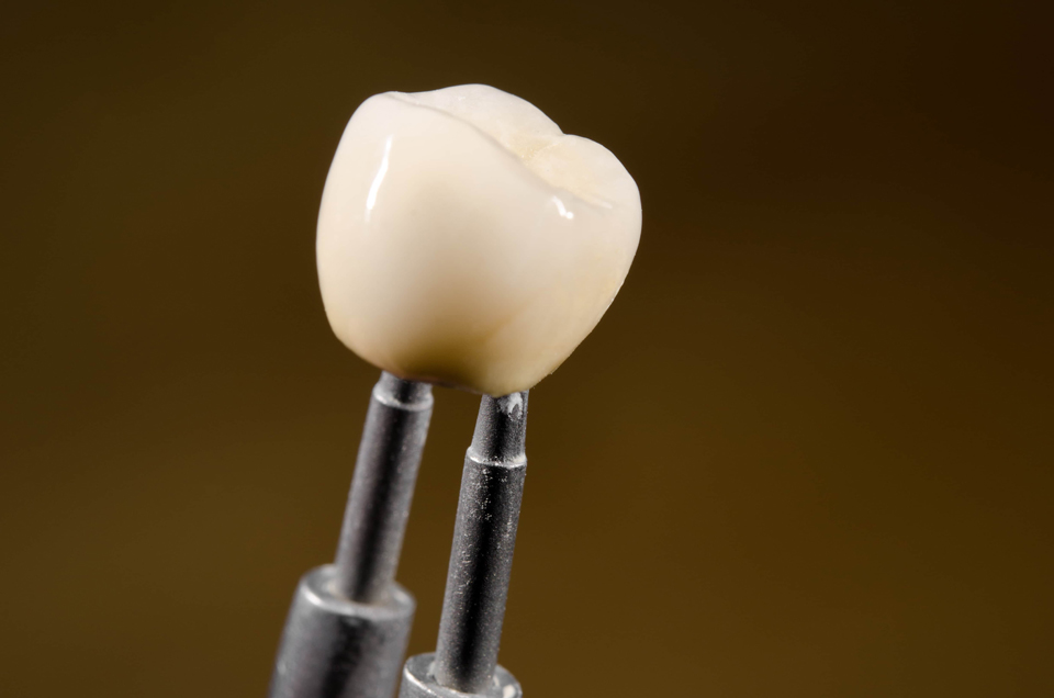 Dental crowns and restoration